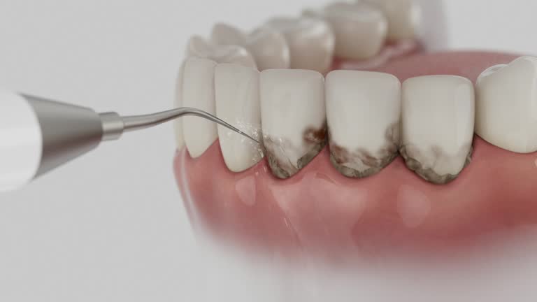 Reliable Dental Implants contractor in Markle, IN by Smile Center Dentistry